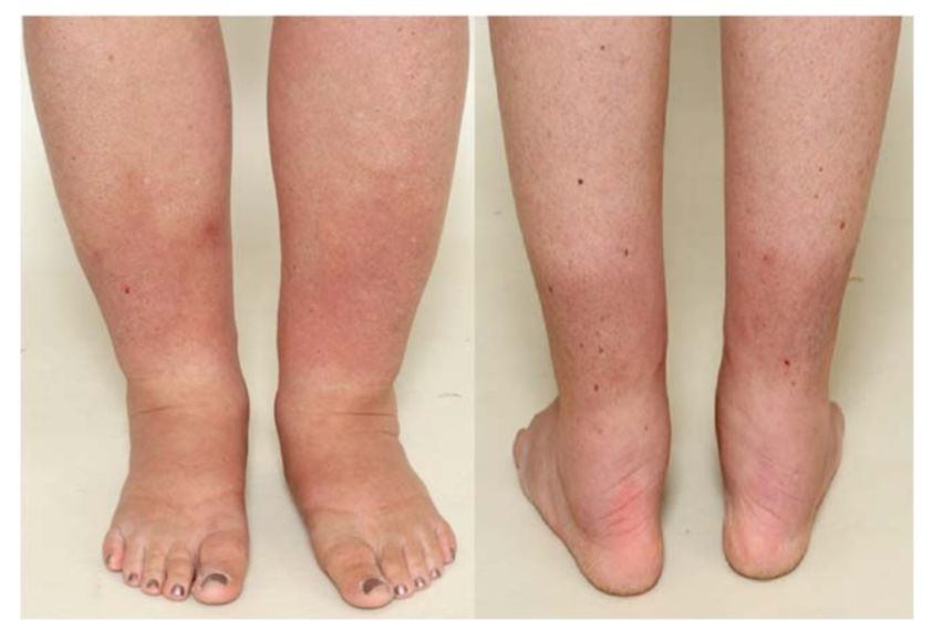 桥本甲状腺炎补硒多少（甲状腺桥本吃硒元素）-硒宝网