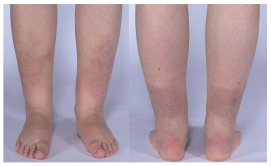 桥本甲状腺炎补硒多少（甲状腺桥本吃硒元素）-硒宝网