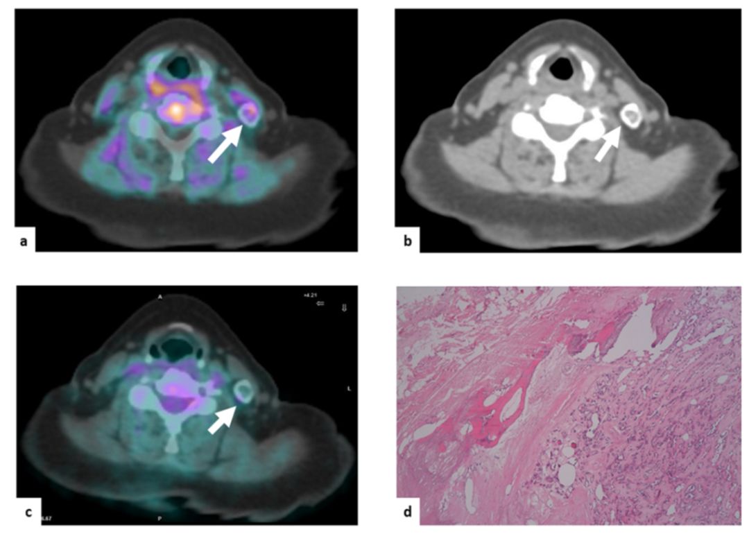 桥本甲状腺炎补硒多少（甲状腺桥本吃硒元素）-硒宝网