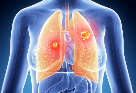 为什么肺癌要大量补硒（肺癌补硒吃什么药）-硒宝网