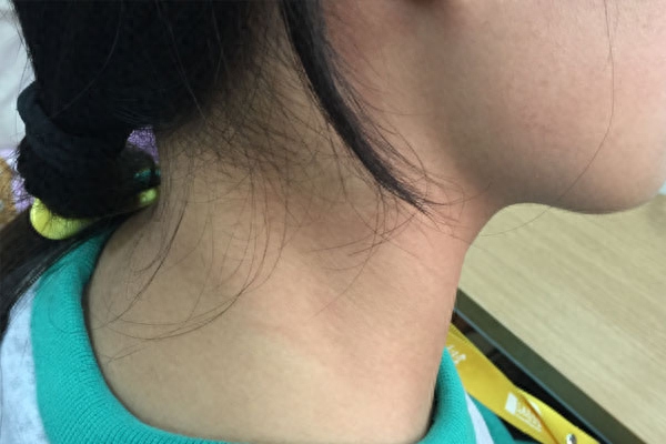 补硒药可以治甲状腺嘛(甲状腺吃补硒的药)-硒宝网