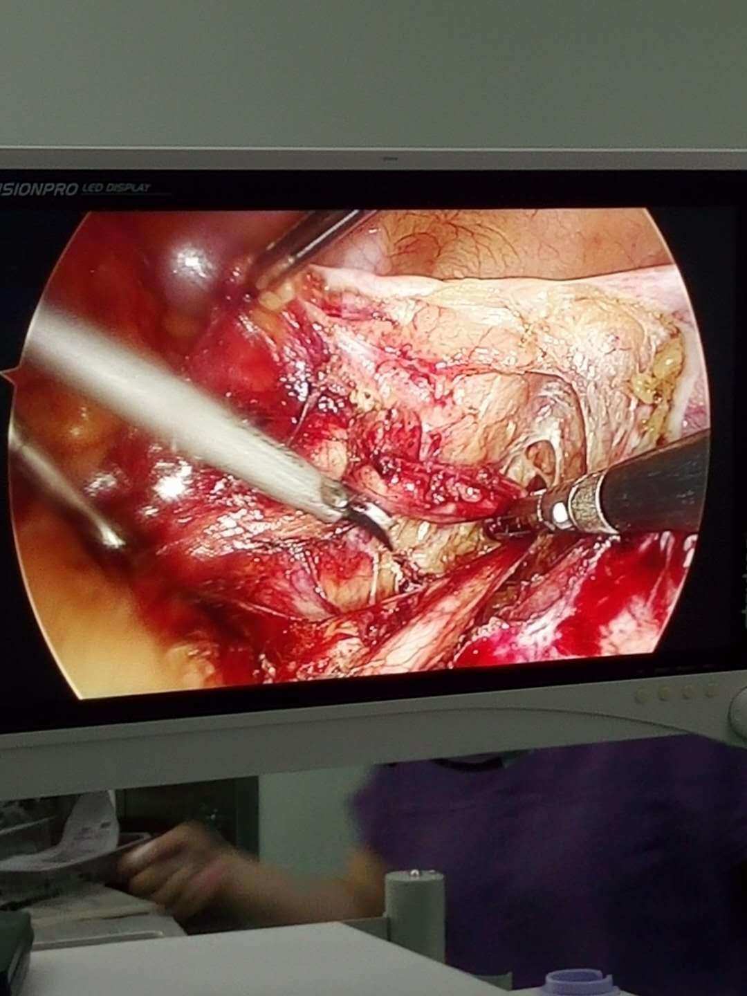 肾盂癌术后可以补硒吗（肾盂癌切除后能活多久）-硒宝网