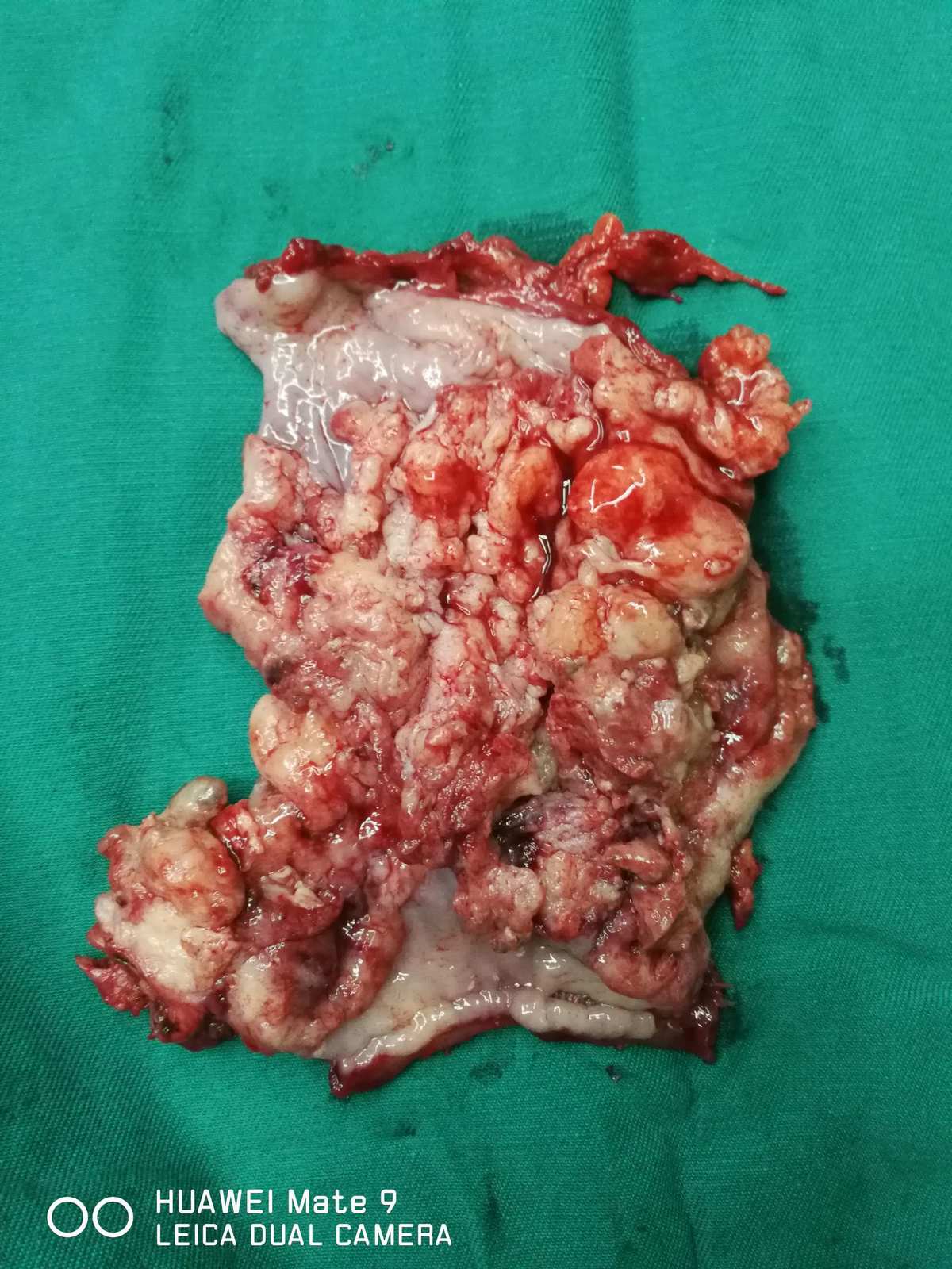 肾盂癌术后可以补硒吗（肾盂癌切除后能活多久）-硒宝网