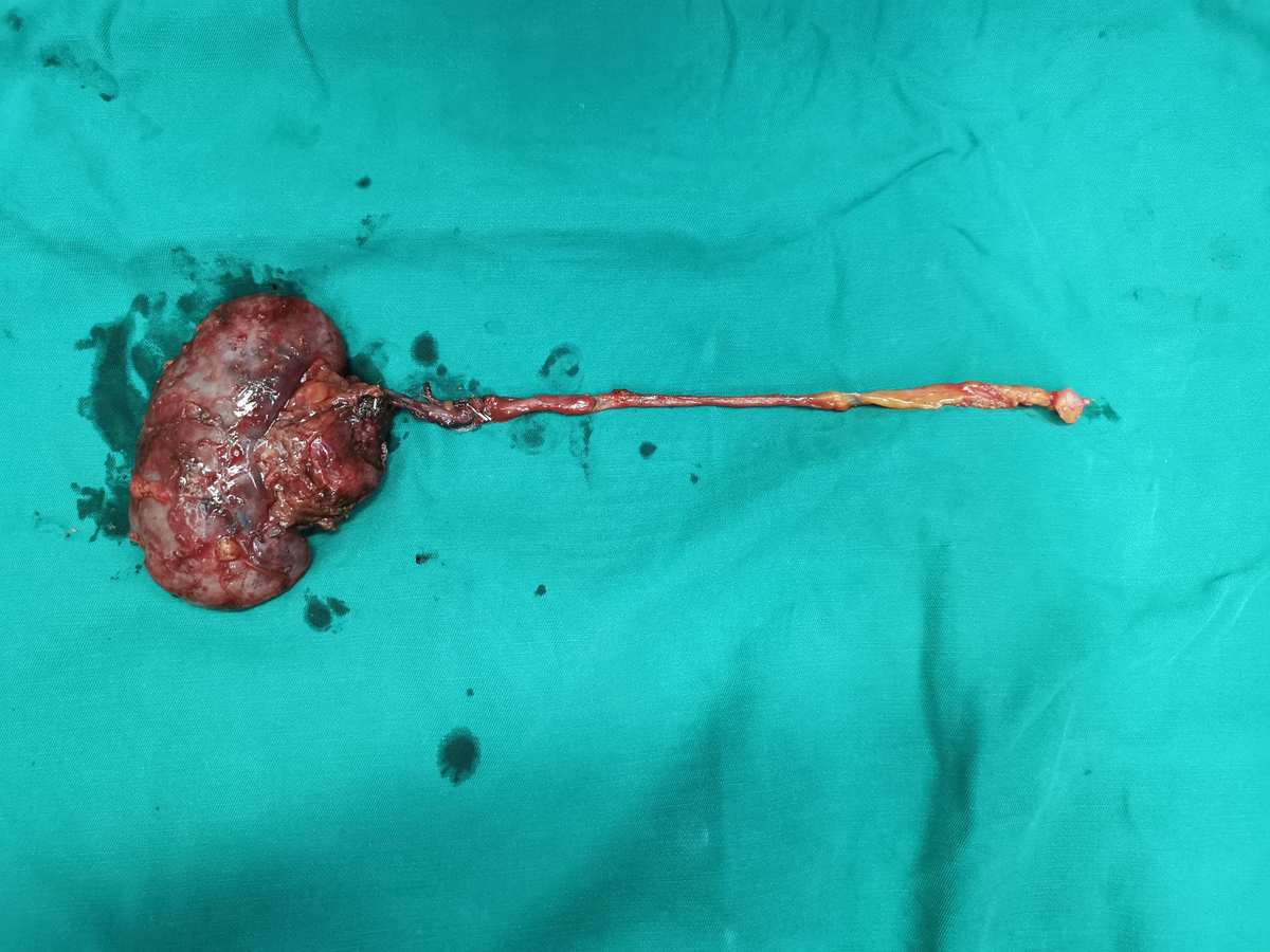 肾盂癌术后可以补硒吗（肾盂癌切除后能活多久）-硒宝网