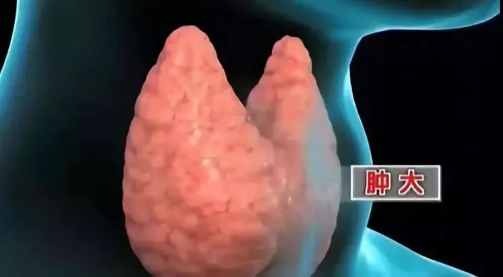 甲状腺结节补硒好不好（好补甲状腺结节硒片有用吗）-硒宝网