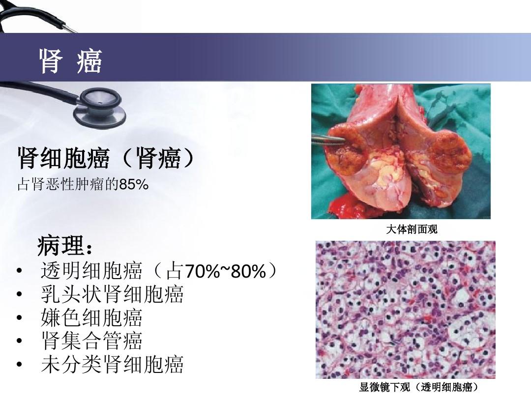 肾盂癌术后可以补硒吗（肾移植后可以补硒吗）-硒宝网