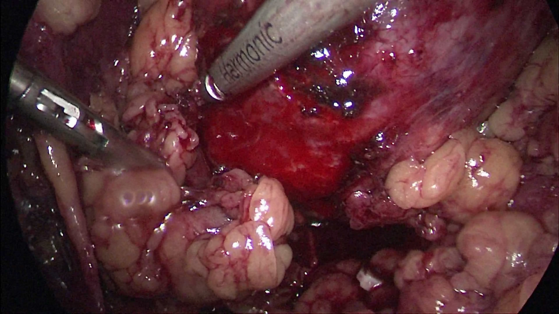 肾盂癌术后可以补硒吗（肾移植后可以补硒吗）-硒宝网