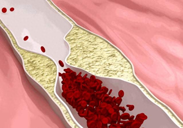 补硒能消除斑块吗女性（补硒能祛斑吗）-硒宝网