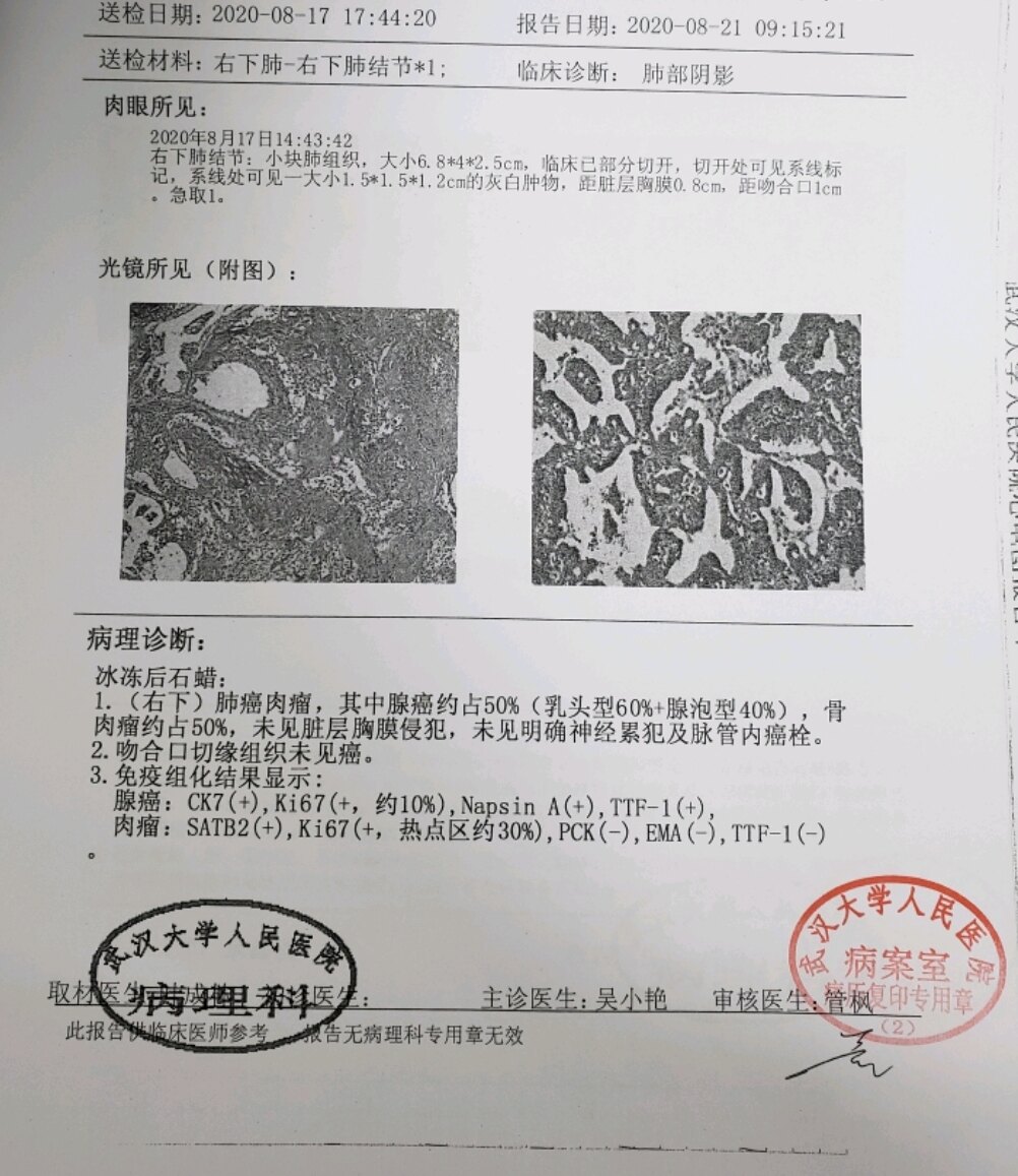 哪些恶性肿瘤不可补硒（肿瘤恶性补硒可以治愈吗）-硒宝网