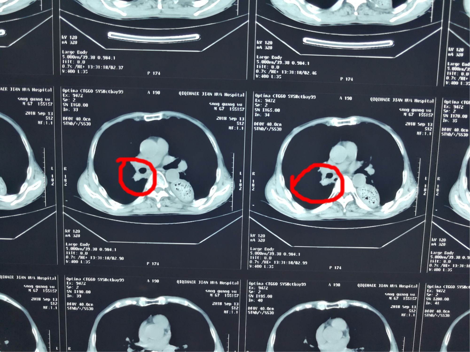 哪些恶性肿瘤不可补硒（肿瘤恶性补硒可以治愈吗）-硒宝网