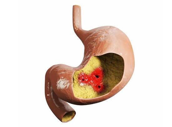 胃癌晚期补硒吃什么好（晚期补胃癌吃好硒片有用吗）-硒宝网