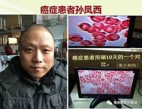 肺癌后期补硒有作用吗（肺癌晚期补硒）-硒宝网