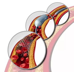 心脏放了支架能补硒吗（支架心脏能补放硒片吗）-硒宝网