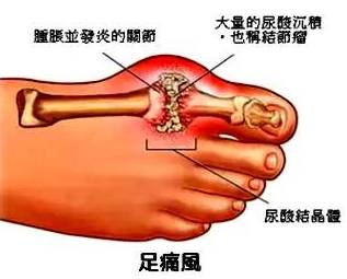 补硒和痛风哪个效果好(痛风补硒有好处吗)-硒宝网