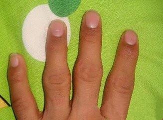 补硒可以治疗大骨节?。ㄎ牍枪亟诓〉墓叵担?硒宝网