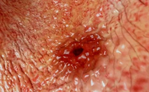 胃溃疡怎么补硒元素多（胃溃疡怎么补硒元素多）-硒宝网