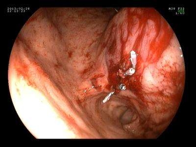胃溃疡怎么补硒元素多（胃溃疡怎么补硒元素多）-硒宝网