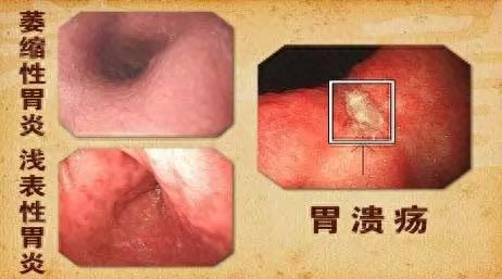 胃溃疡怎么补硒元素多（胃溃疡怎么补硒元素多）-硒宝网