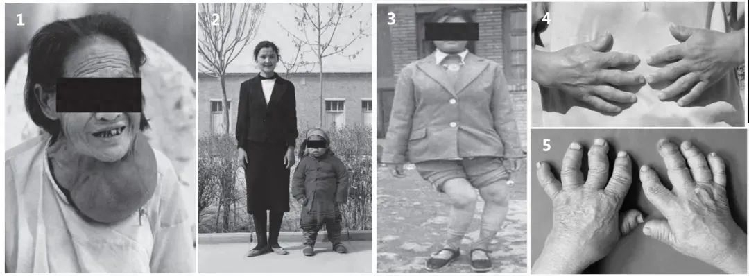 器官衰竭病人要补硒吗(吃硒治疗肾衰竭)-硒宝网