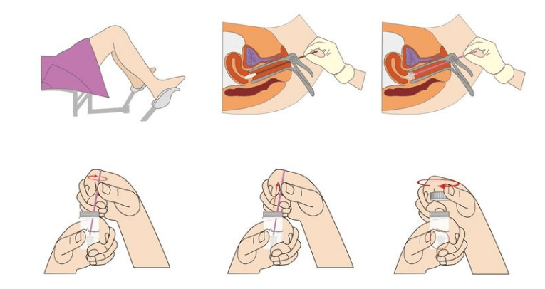 治疗hpv补硒有用吗(补硒对hpv有效果吗)-硒宝网