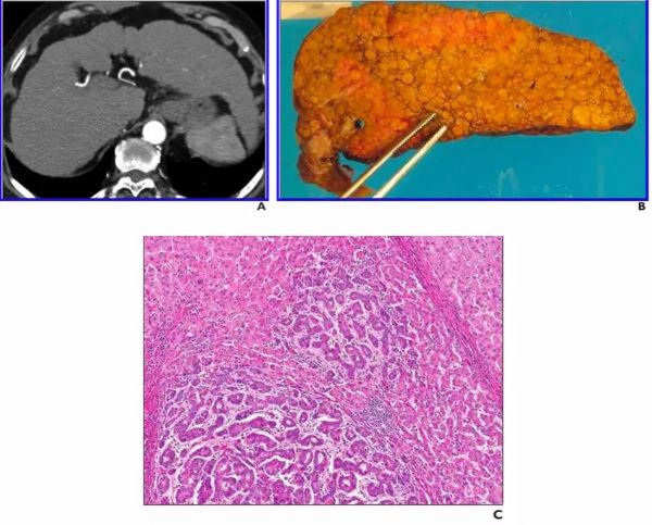 肝炎用什么补硒药物好(肝病补硒)-硒宝网