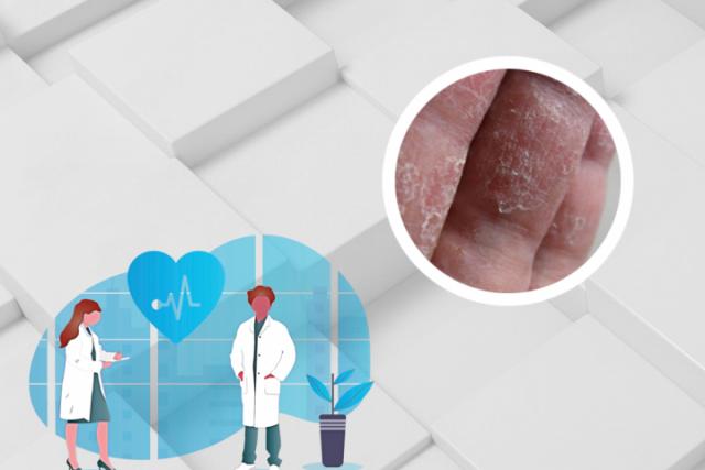 银屑病人每天补硒多少(每天补充硒)-硒宝网