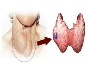 甲状腺切除后能补硒吗(甲状腺全切可以吃硒酵母片吗)-硒宝网