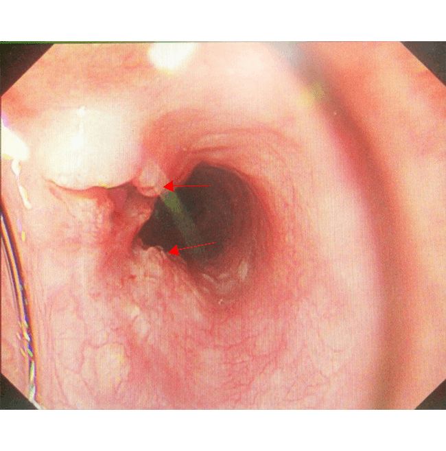 经常补硒还会得癌症吗(得了癌症补硒有用吗)-硒宝网