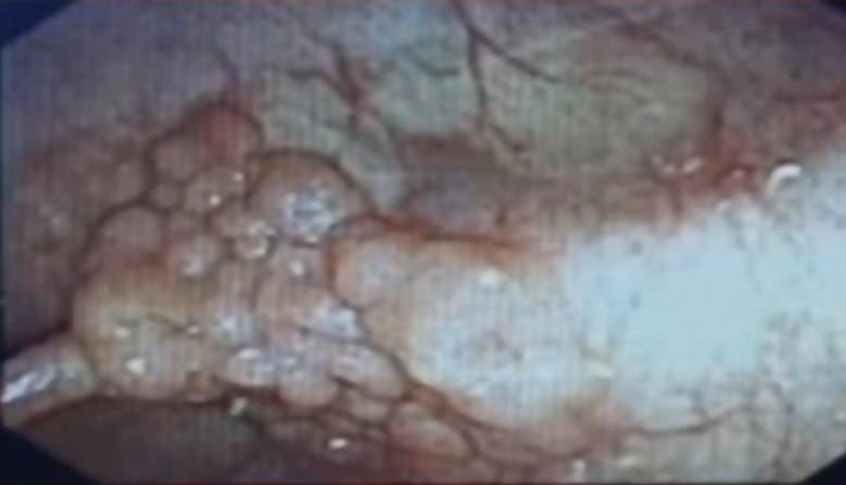 肠息肉补硒有什么好处（切除了肠息肉能吃硒元素吗）-硒宝网