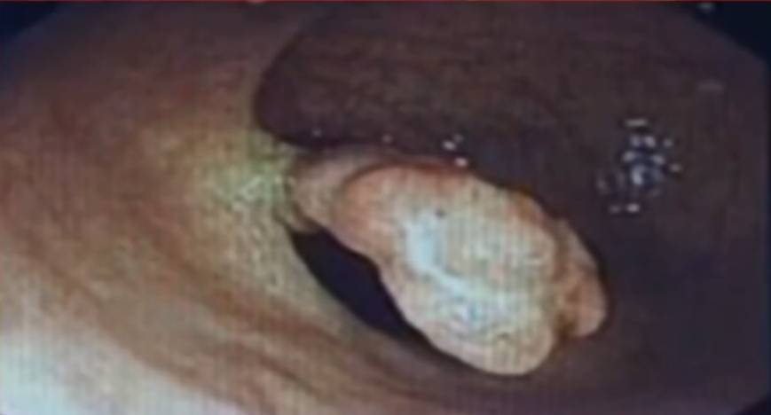 肠息肉补硒有什么好处（切除了肠息肉能吃硒元素吗）-硒宝网