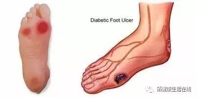 天天补硒能否治脑血栓(补硒对脑血栓有效果吗)-硒宝网