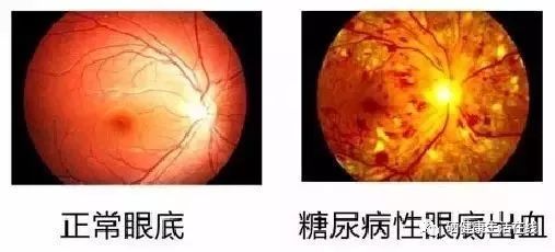 天天补硒能否治脑血栓(补硒对脑血栓有效果吗)-硒宝网