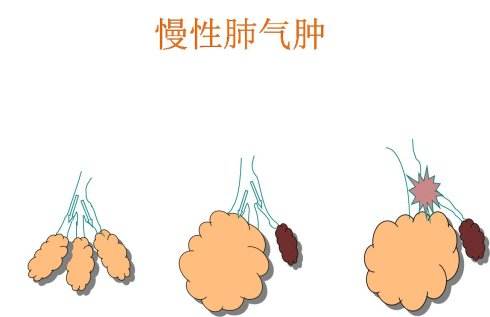 补硒可以改善肺气肿吗（硒对肺有什么好处）-硒宝网