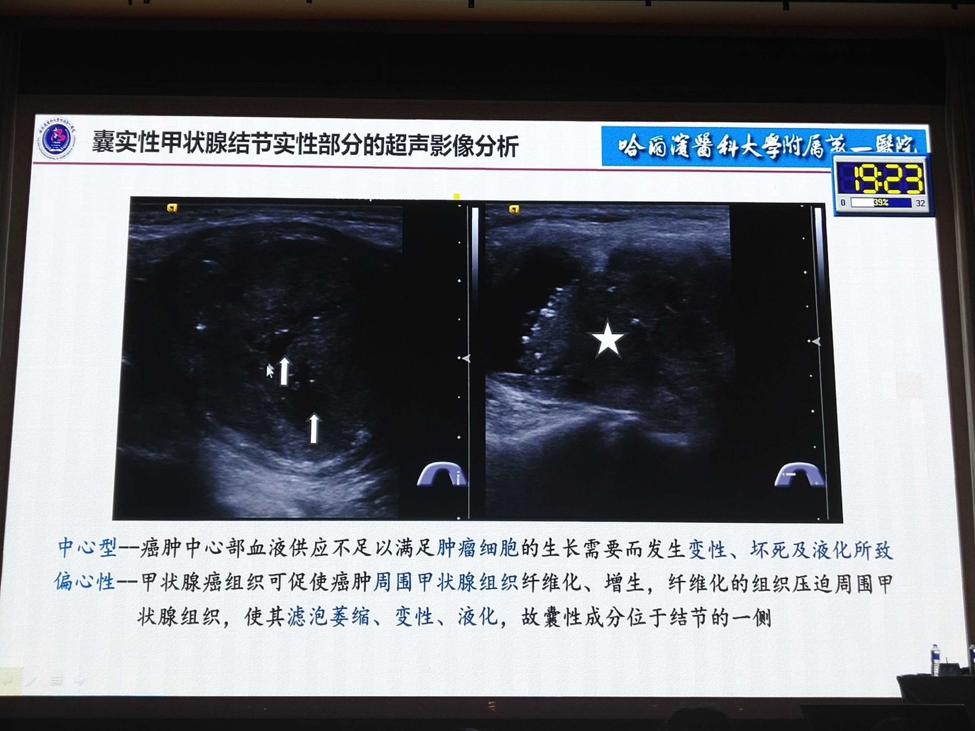甲状腺结节一定要补硒(甲状腺结节补硒有什好处)-硒宝网