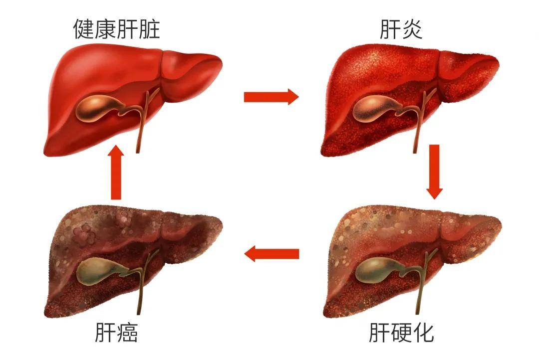 肝硬化腹水可以补硒吗(肝硬化腹水吃硒片有效果吗)-硒宝网