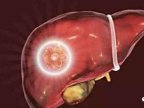 癌症补硒好吗吃什么好(得了癌症吃硒还有用吗)-硒宝网