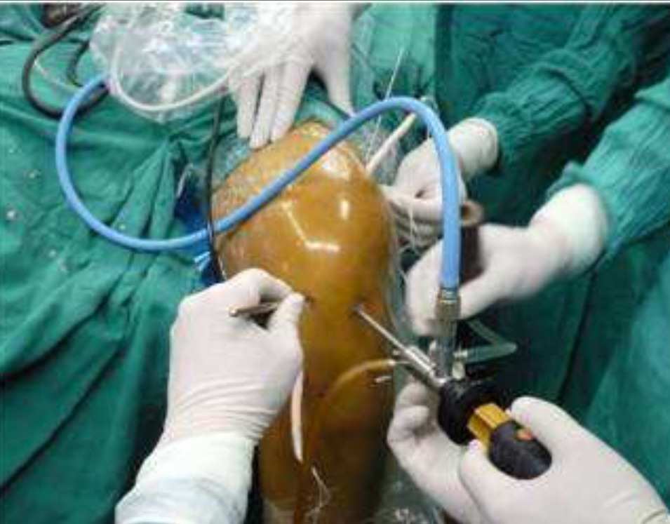 大骨关节疾病补硒方案(硒对骨关节的作用)-硒宝网