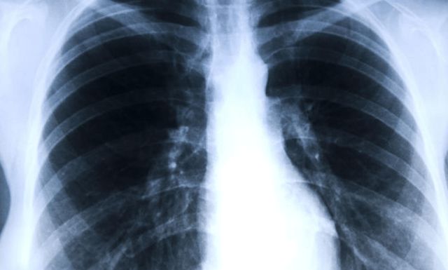 肺上有结节可以补硒吗（肺上有结节可以补硒吗）-硒宝网