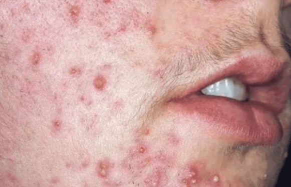 补硒对皮肤瘙痒有用吗（瘙痒补皮肤硒用有副作用吗）-硒宝网