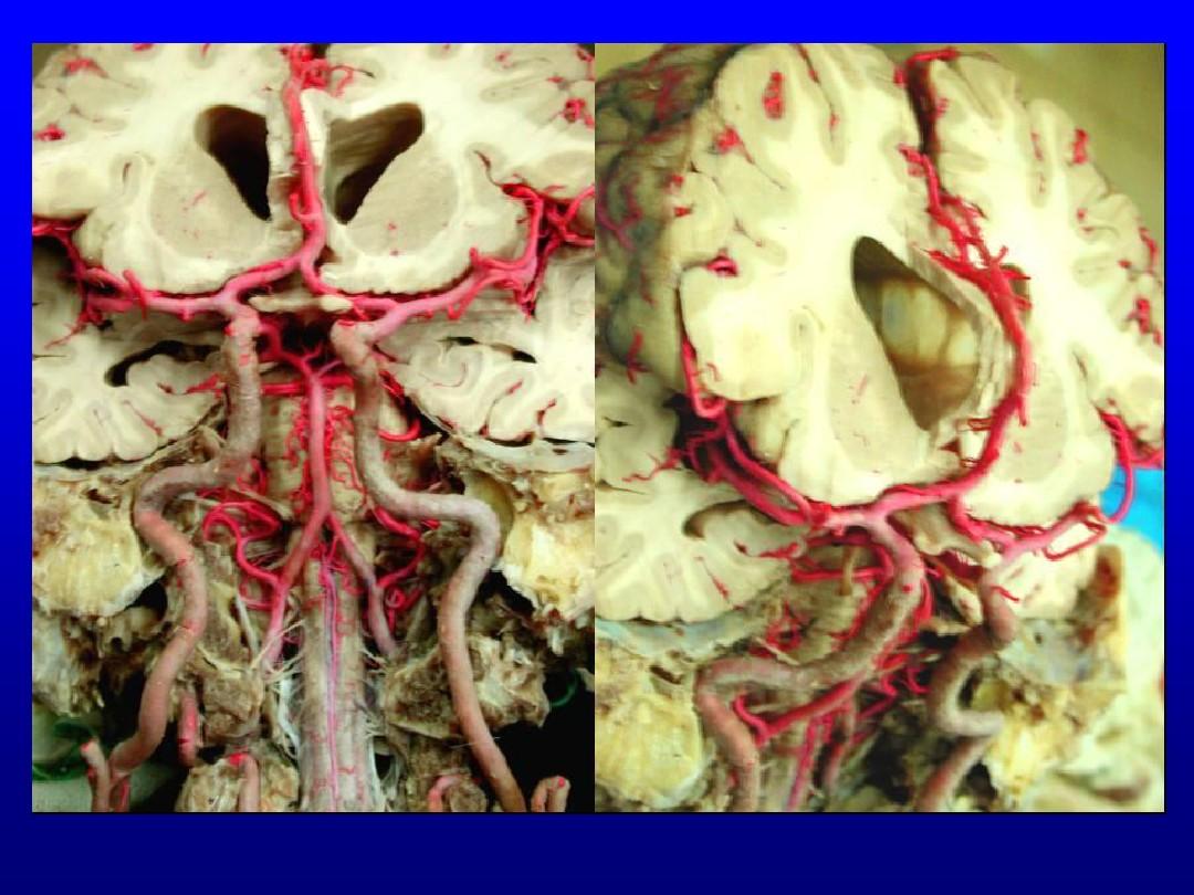 血管有斑块补硒有用吗(血管斑块保健品)-硒宝网