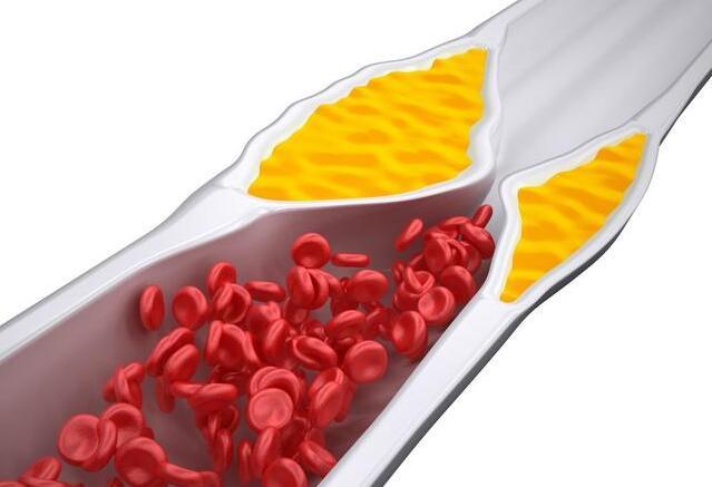 血管有斑块补硒有用吗(血管有斑块补硒有用吗)-硒宝网