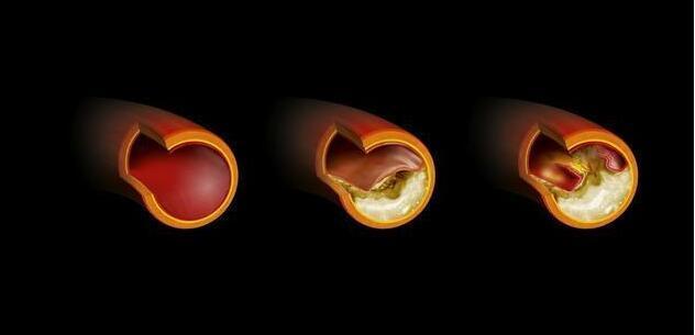 血管有斑块补硒有用吗(血管有斑块补硒有用吗)-硒宝网