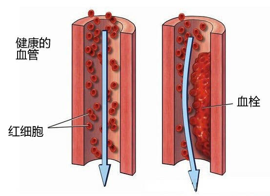 血管有斑块补硒有用吗（有血管补斑块硒用量多少）-硒宝网