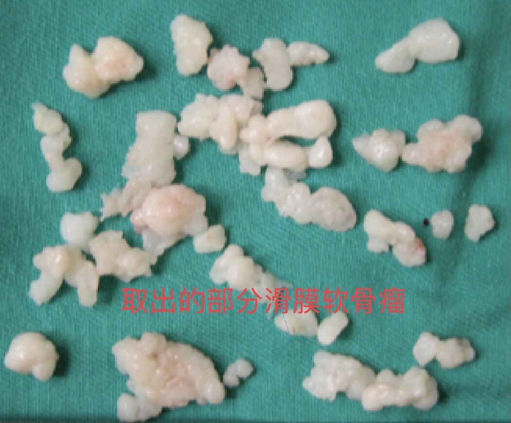 补硒会导致口腔溃疡嘛（口腔溃疡和缺硒有关吗）-硒宝网