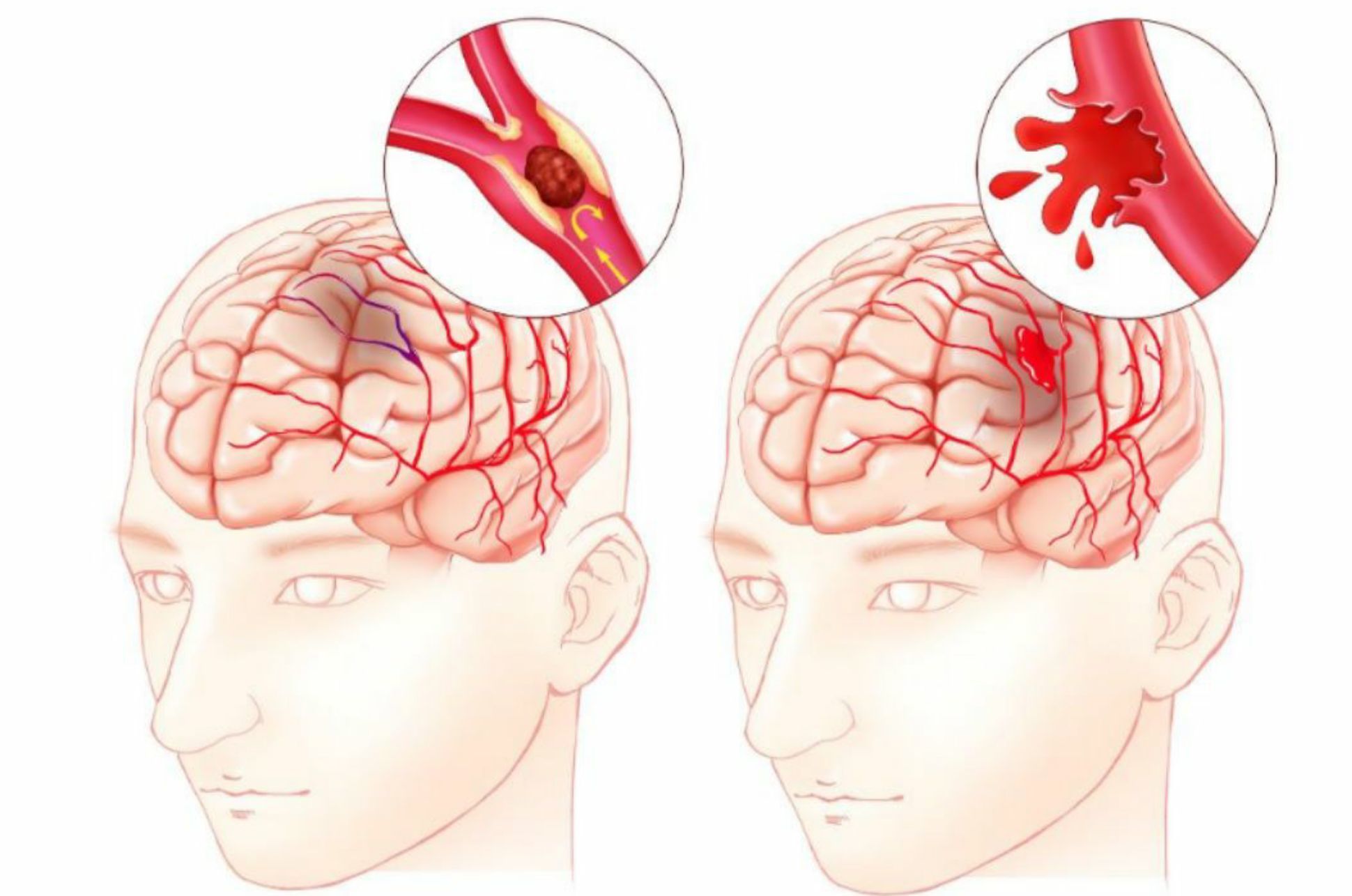 脑出血病人补硒重要吗(出血脑病人补重要硒片有用吗)-硒宝网