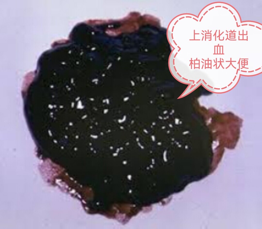 胃溃疡怎么补硒好的快(胃溃疡吃补品)-硒宝网