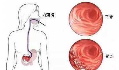 硒维康 胃癌（胃癌硒）-硒宝网