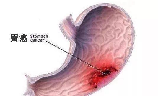 硒维康 胃癌（胃癌硒）-硒宝网