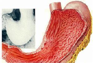 胃炎病人补硒（胃炎可以补硒吗）-硒宝网