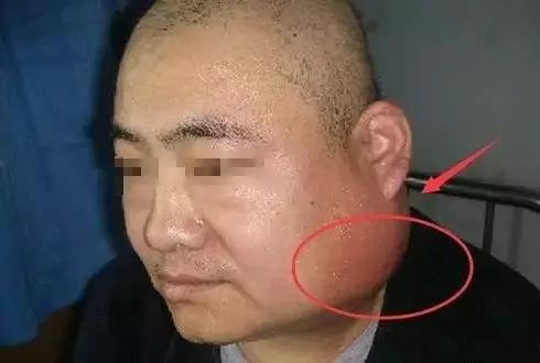 补硒降低血沉（补降低硒血沉的中药）-硒宝网